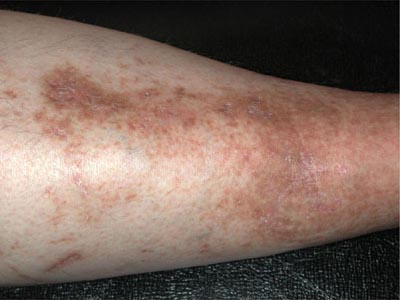 შამბერგის დაავადება