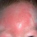 cellulitis