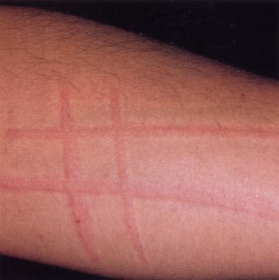 ჭინჭრის ციება