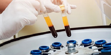 პლაზმოთერაპია